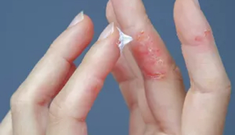 Microbiota y piel: dermatitis atópica