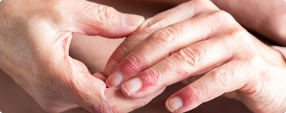 Microbiota y piel: dermatitis atópica